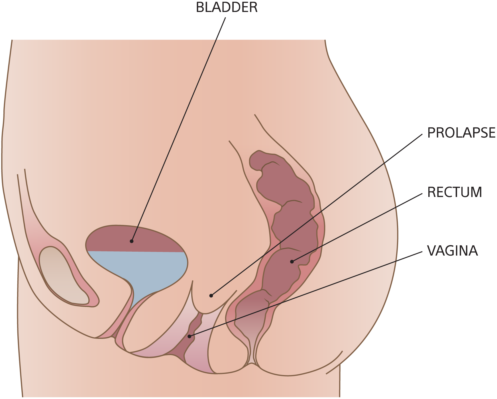 Illustration of vaginal vault prolapse.