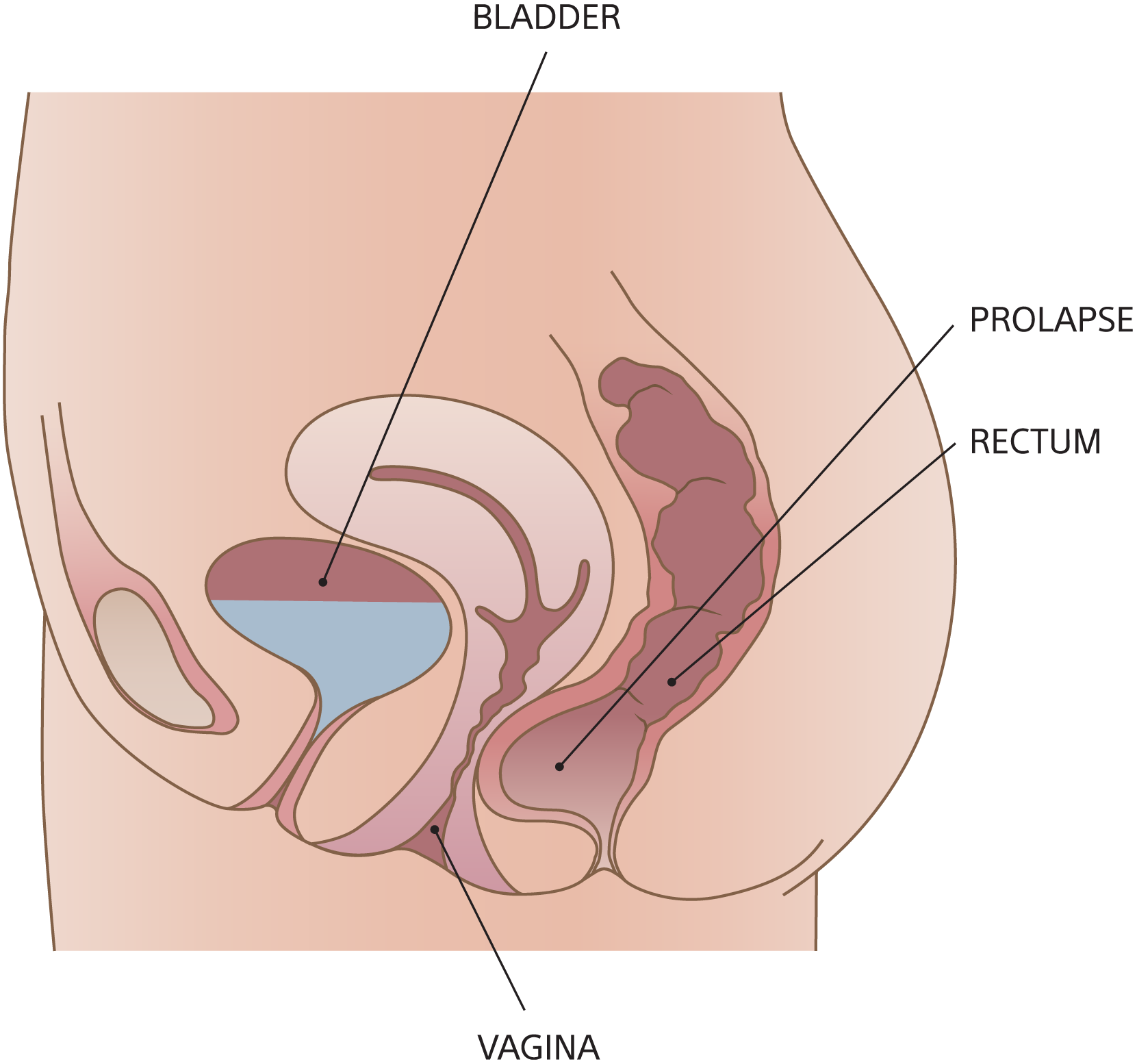 Illustration of rectocele.
