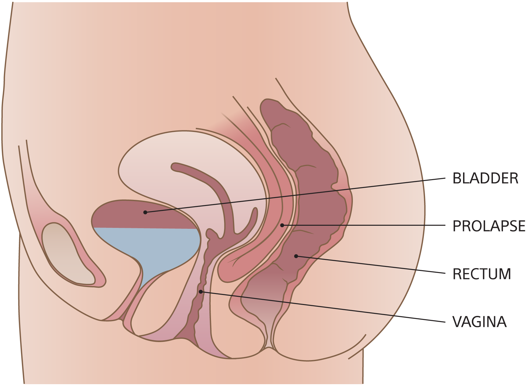 Illustration of enterocele.