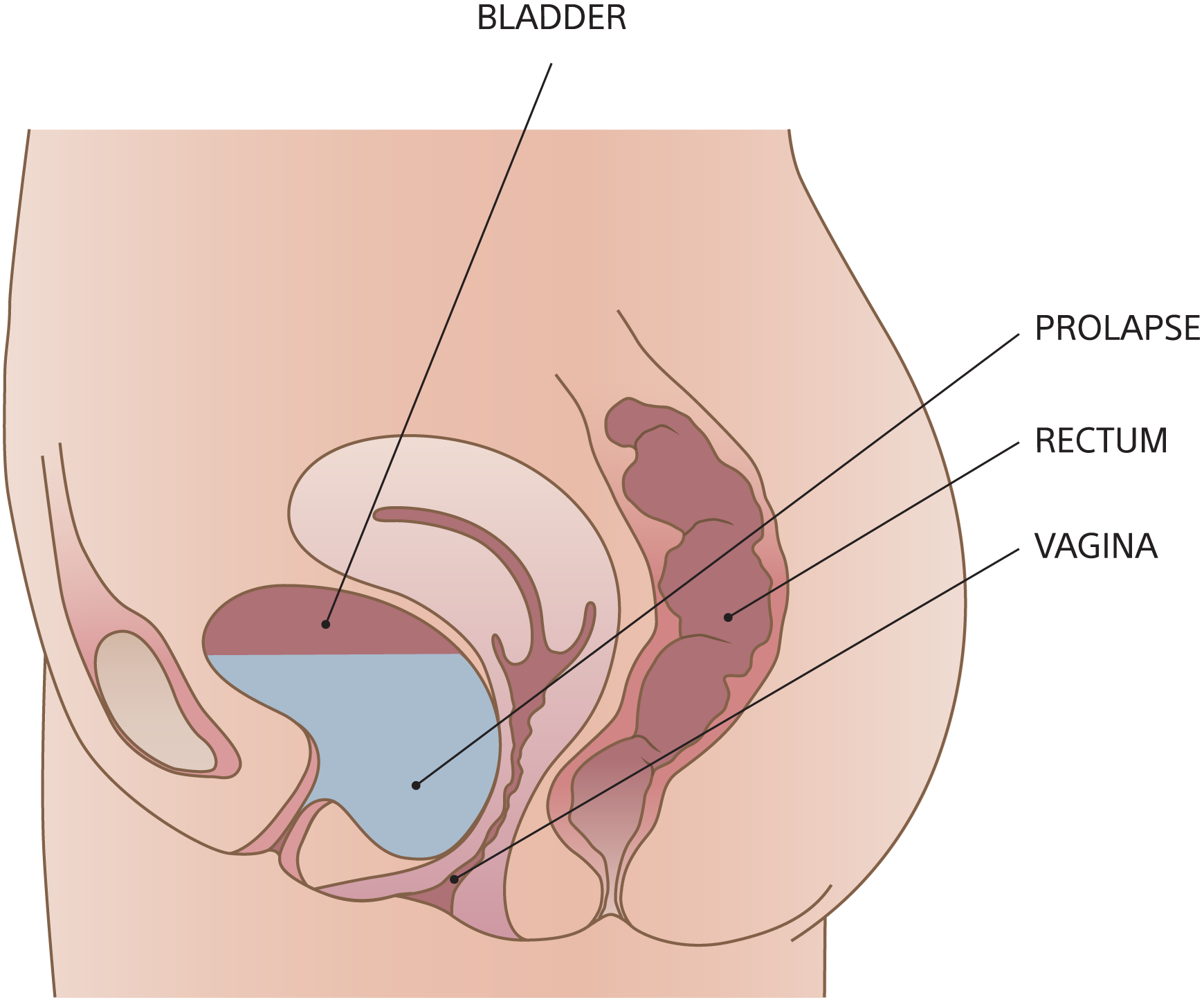 Illustration of cystocele.