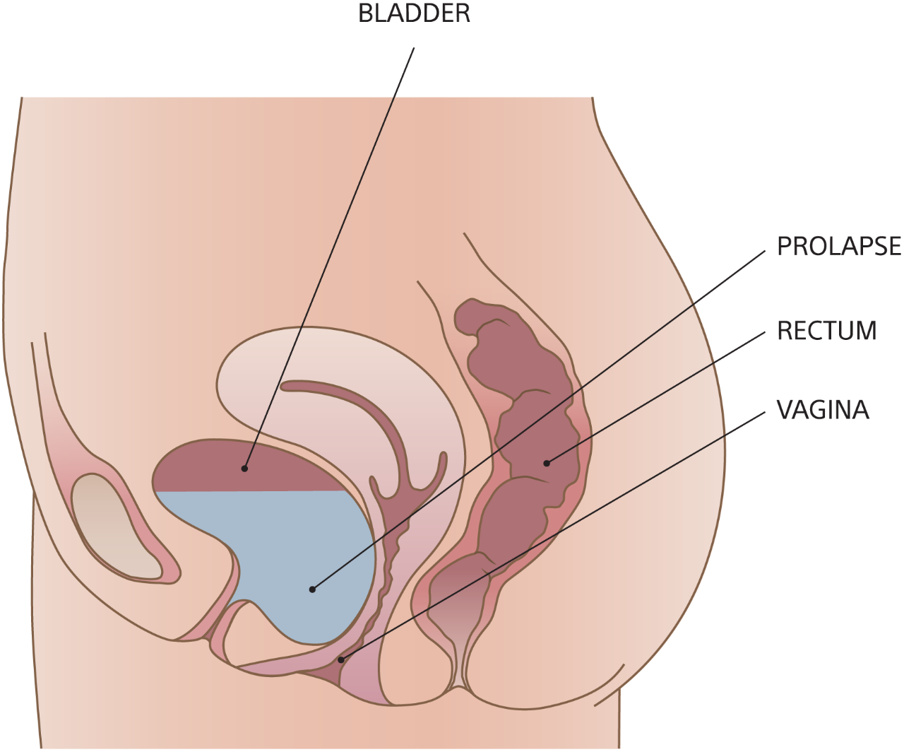Diagram of cystocele formation with bladder, rectum, vagina, and prolapse.
