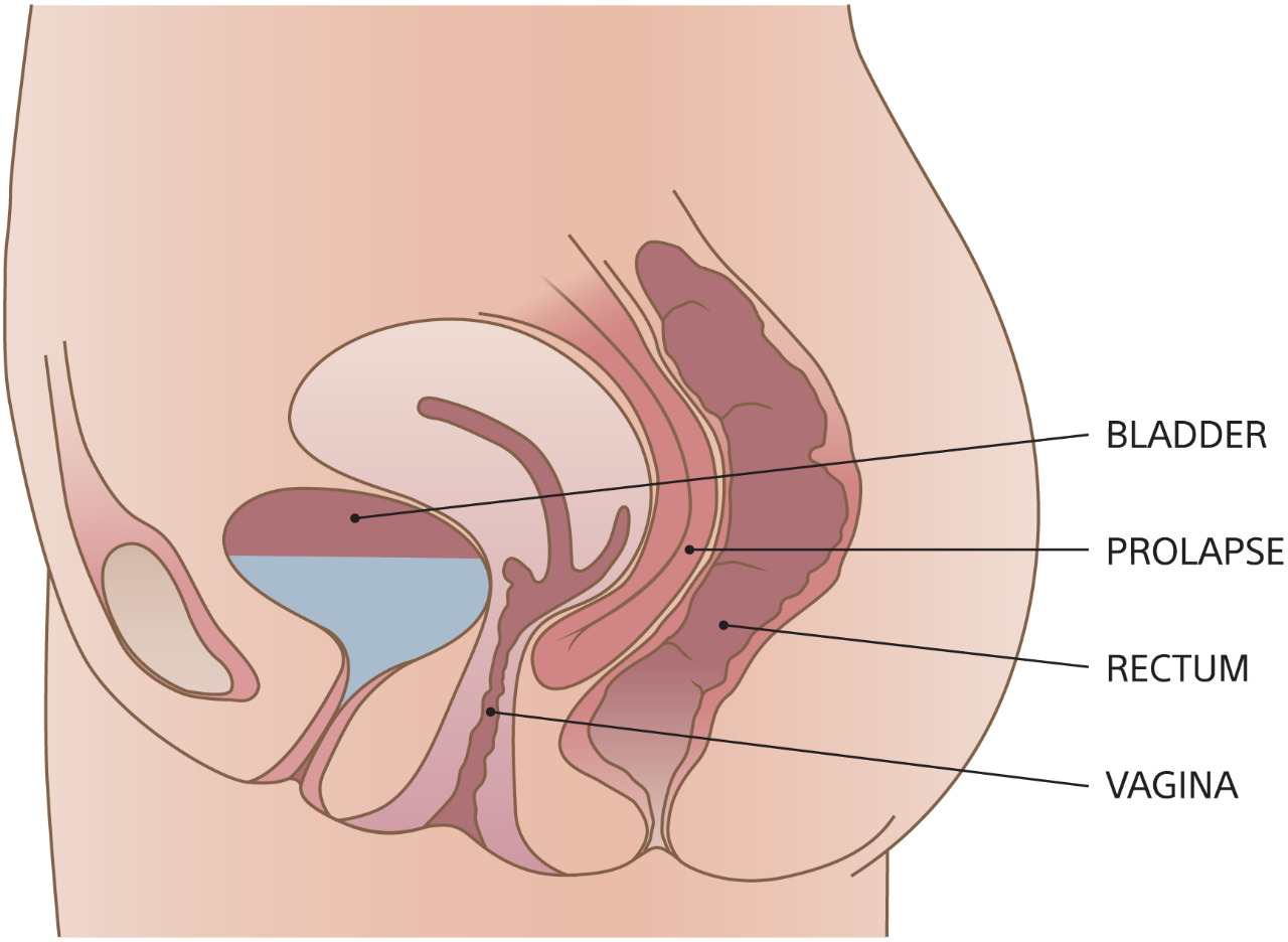 Illustration of enterocele.