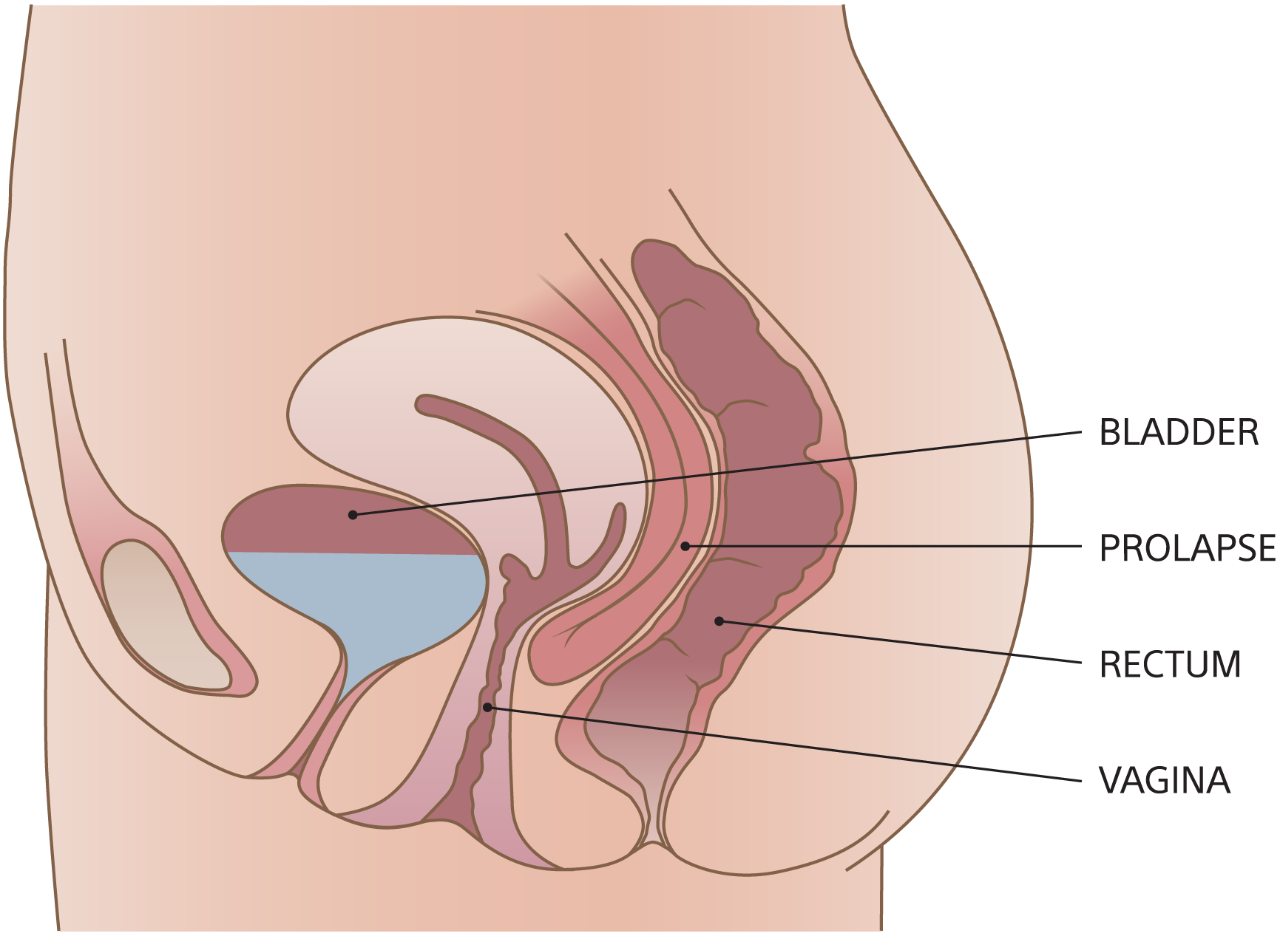 Diagram of enterocele with bladder, rectum, vagina, and prolapse.