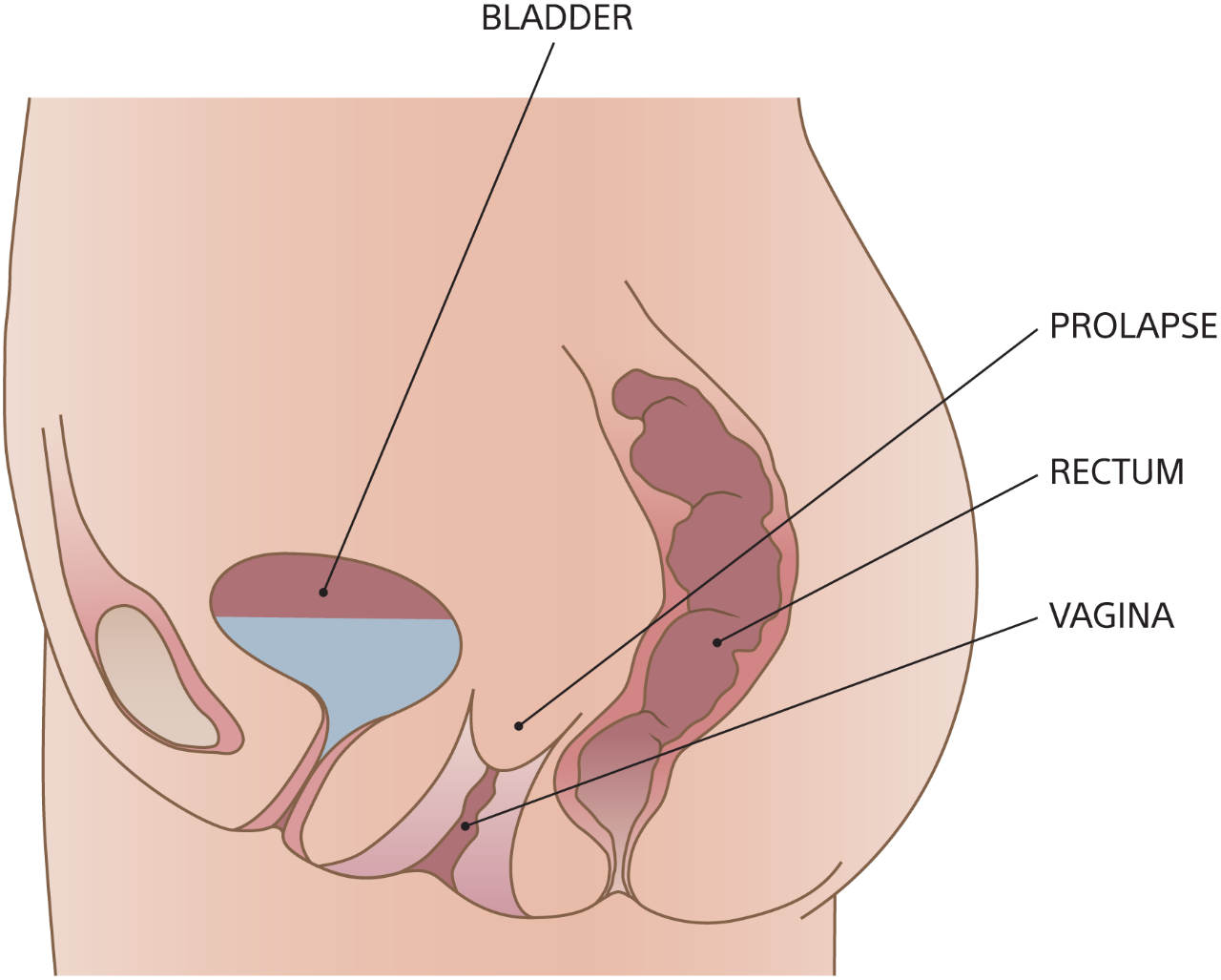 Diagram of vaginal vault prolapse with bladder, rectum, vagina, and prolapse.