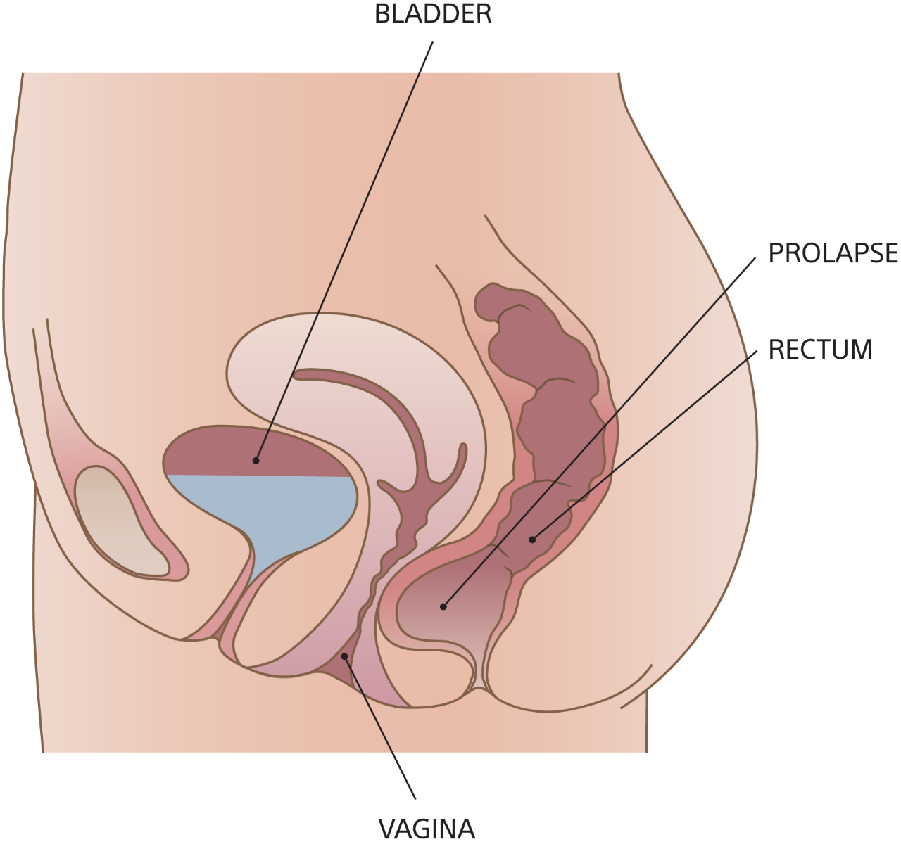 Illustration of rectocele.