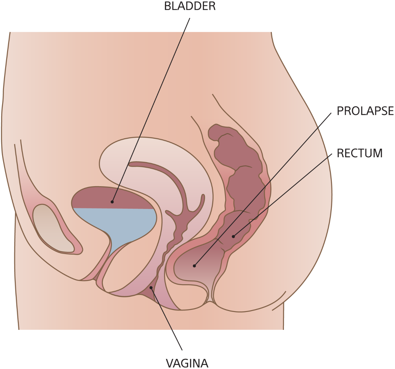 Diagram of rectocele with bladder, rectum, vagina, and prolapse.